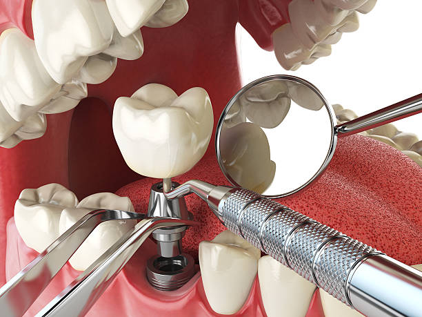Best Knocked-Out Tooth (Avulsed Tooth) Treatment in Union City, IN